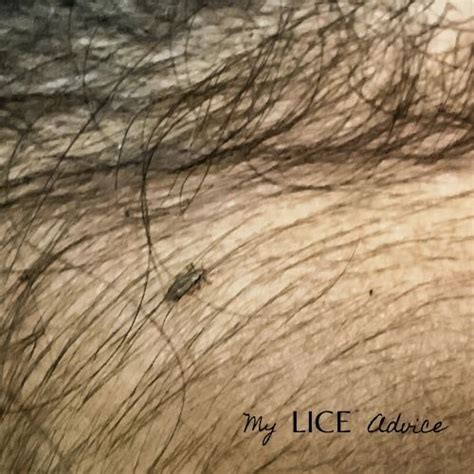 Black Lice and Lice in Black Hair (with Pictures) - My Lice Advice