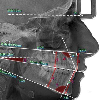 The Main Cephalometric Points And Measurements According To The COGS