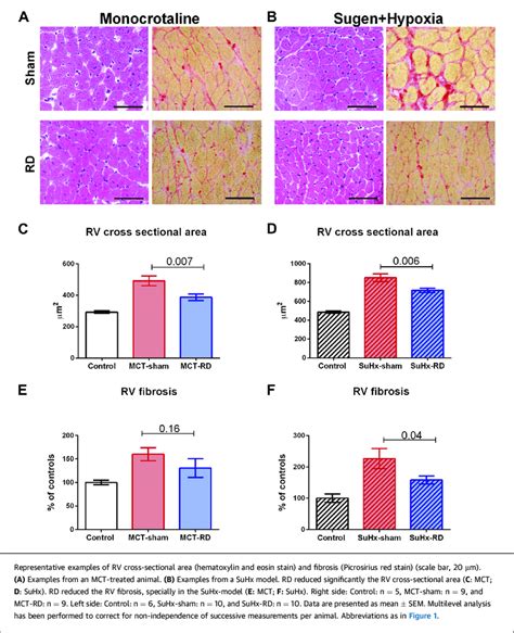 Renal Denervation Reduced Right Ventricular Hypertrophy And Fibrosis