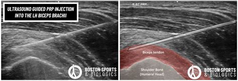 Boston Sports The Role Of Regenerative Medicine In Orthopedics