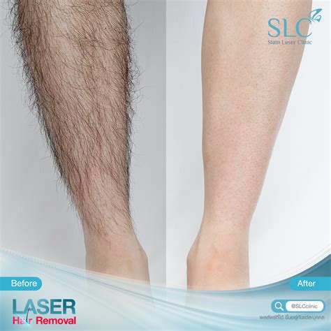 โปรแกรมกำจัดขนด้วย Gentle Yag Laser ผิวเรียบเนียนไร้ขน Hair Removal