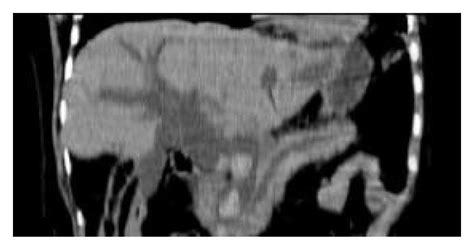 Role Of Curved Planar Reformations Using Multidetector Spiral Ct In