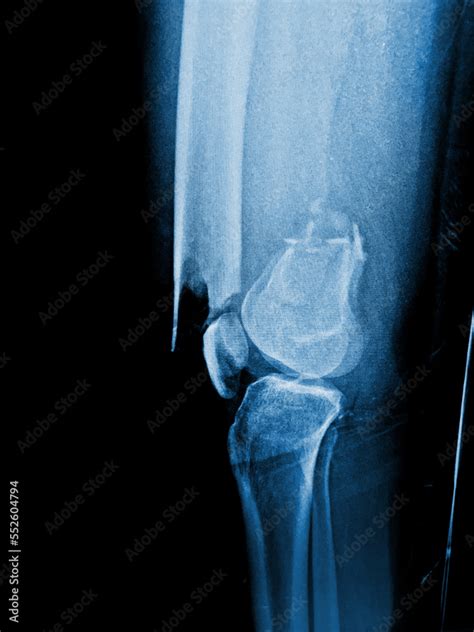 X-ray femur show complete fracture Stock Photo | Adobe Stock