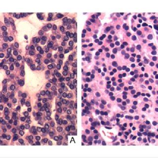 Histological Appearance Of Thyroid Tissue A And Endobronchial Biopsy