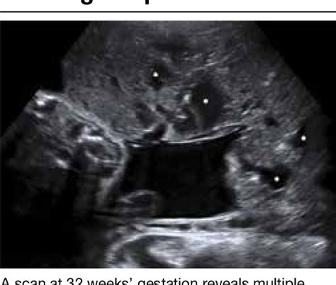 Diagnosing Placenta Accreta Spectrum With Prenatal Ultrasound