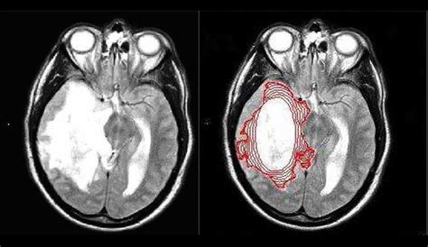 On the left, T 2-weighted image of a glioblastoma multiforme. Right ...