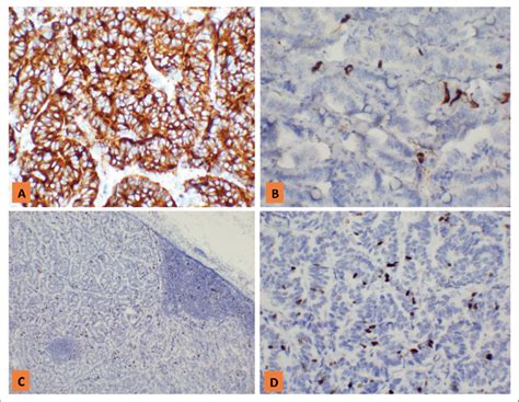 inmunohistoquímica ihq A Sinaptofisina positiva difusa patrón