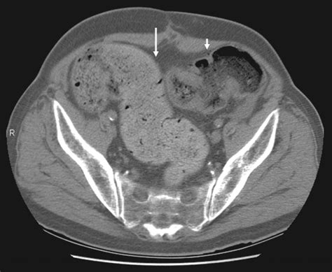 Stercoral Colitis Leading To Fatal Peritonitis Ct Findings Ajr