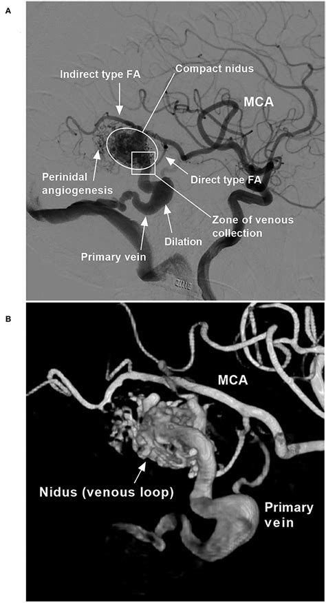 Frontiers Intra And Post Operative Acute Hemorrhagic Complications