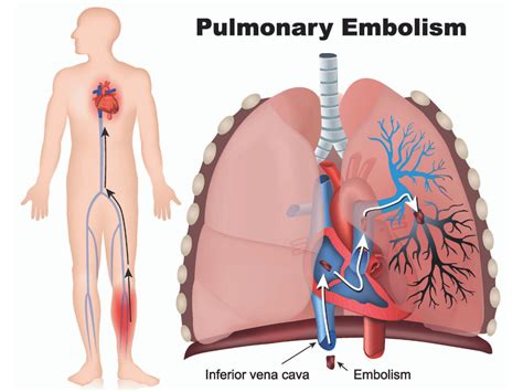 Pulmonary Embolism | My Vascular Health