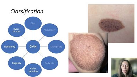 Publication Presentation Care Of Congenital Melanocytic Nevi In