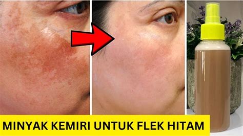 Mau Flek Hitam Hilang Permanen Manfaat Minyak Kemiri Untuk Wajah