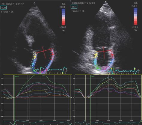 Left Atrial Strain Curves Obtained From Four And Two Chamber Views Download Scientific