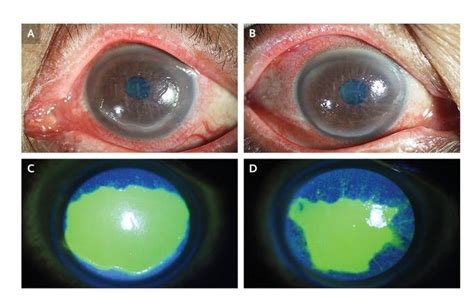 Keratoconjunctivitis Sicca In Sj Grens Syndrome Medizzy