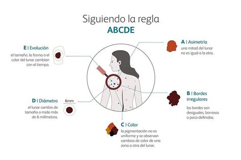 Día Mundial del Melanoma cinco tips para hacer un autochequeo y