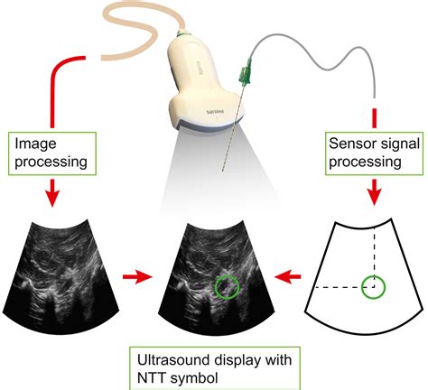 The Effect Of Needle Tip Tracking On Procedural Time Of Ultrasound