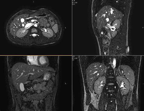 Kidney Mri Images