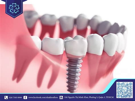 CẤY GHÉP IMPLANT KHÔNG ĐAU TẠI NHA KHOA FLORA