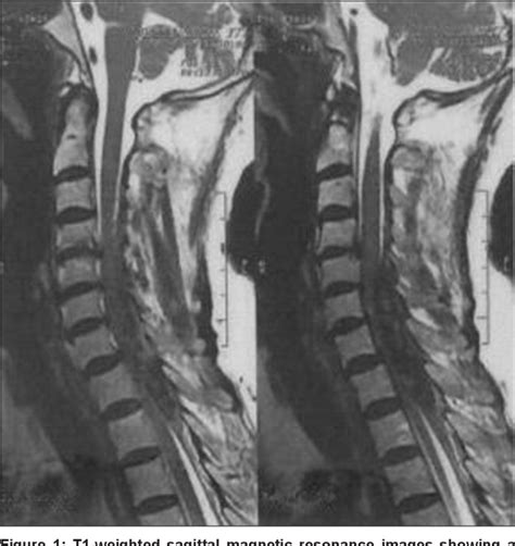 Figure 1 From Spontaneous Cervical Epidural Hematoma With Stroke