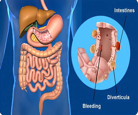 Whats The Difference Between Diverticulitis And Diverticulosis