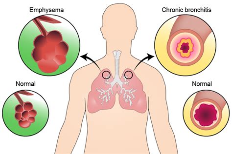 Chronic Bronchitis Lungs