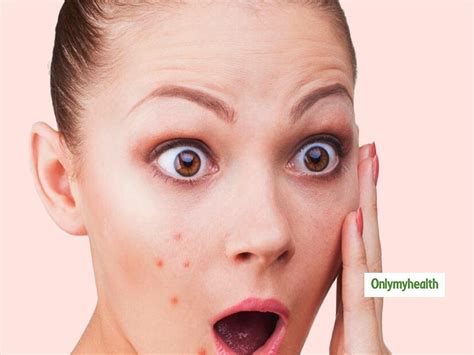 Hormonal Acne What It Is And How It Can Be Cured Onlymyhealth