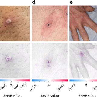 SHAP Analysis Of The MPXV CNN Photographic Images Of MPXV Skin Lesions