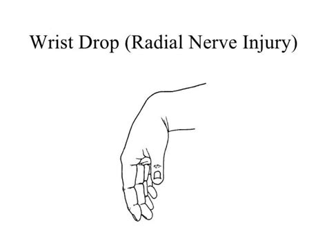 Radial Nerve Palsy Splint Dynamic Wrist Drop Finger, 49% OFF