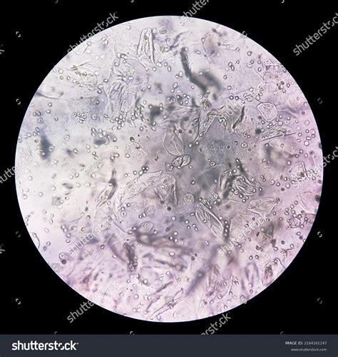 Microscopic Urine Examination Showing Hyaline Cast Stock Photo ...