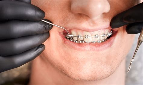 Does Orthodontic Treatment Braces Cause TMJ