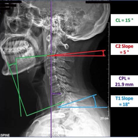 Cervical Radiographic Parameters Measured Including The Cervical Download Scientific Diagram