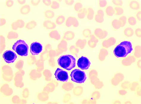 Blood Smear From June 2018 Showing The Presence Of Circulating Plasma