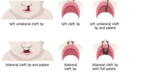 Oral Pathology Flashcards Quizlet