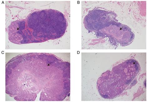 Representative Hematoxylin Eosin Stained Sections Of Central Metastatic