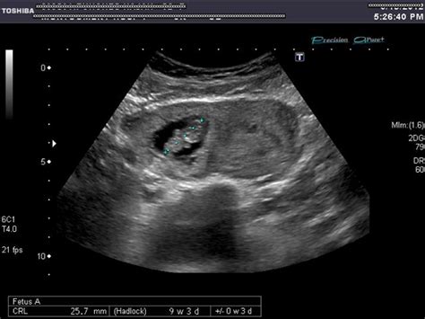 Live Cornual Ectopic Pregnancy