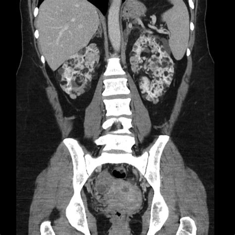 Tuberous Sclerosis Multiple Angiomyolipomas Image