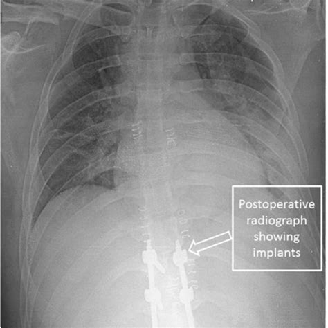 Postoperative Radiograph Showing Surgical Implants Download