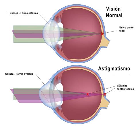 Un defecto muy común el Astigmatismo Elisa Aribau