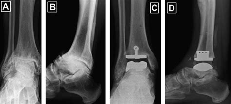 Salto Talaris Fixed Bearing Total Ankle Replacement System Clinics In