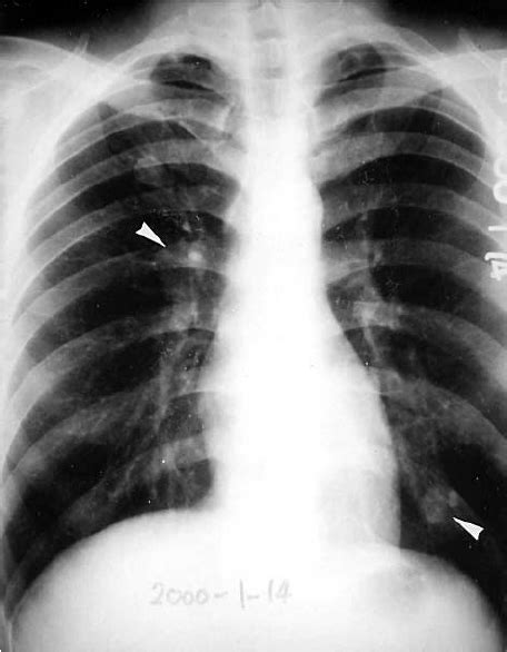 Posterior Anterior Chest Radiography Showing Right Upper Lobe And Left