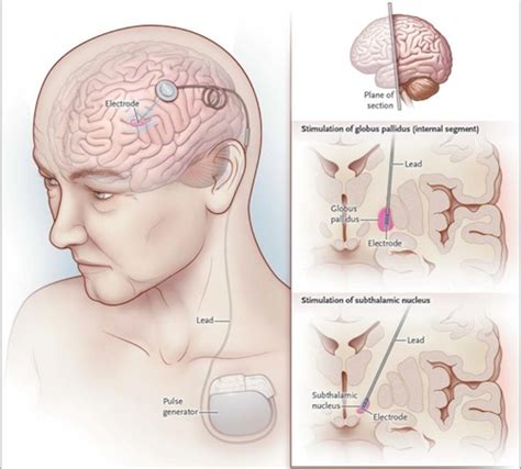 Deep Brain Stimulation Helpful In Some Patients With MS Tremor