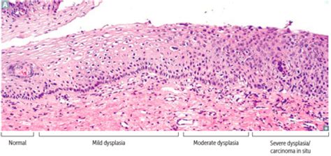 Altered Cellular And Tissue Biology Flashcards Quizlet