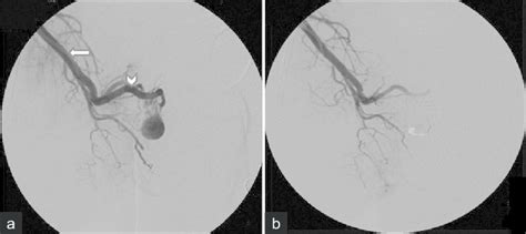 A Right Internal Iliac Artery Angiogram Shows Internal Pudental Download Scientific Diagram