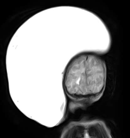 Giant Occipital Encephalocele Radiology Case Radiopaedia Org