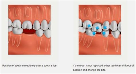 Welcome to Aava Dental: What is the Dental Bridge Procedure