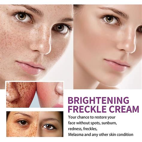 Nicotinamide Whitening Freckle Removing Cream Effectively Remove