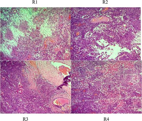 Histologic Description Of Rhabdoid Meningioma Brain WHO Grade II