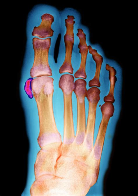 Calcified Toe Bone Photograph By Aj Photoscience Photo Library Pixels