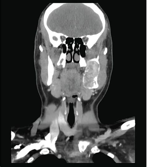 Panoramic Radiograph Revealed A Multilocular Radiolucency In The Body