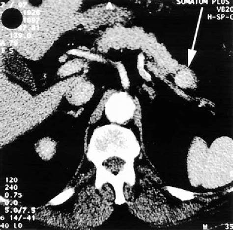 Figure 1 From Intrapancreatic Accessory Spleen A Rare Cause Of A Pancreatic Mass Semantic